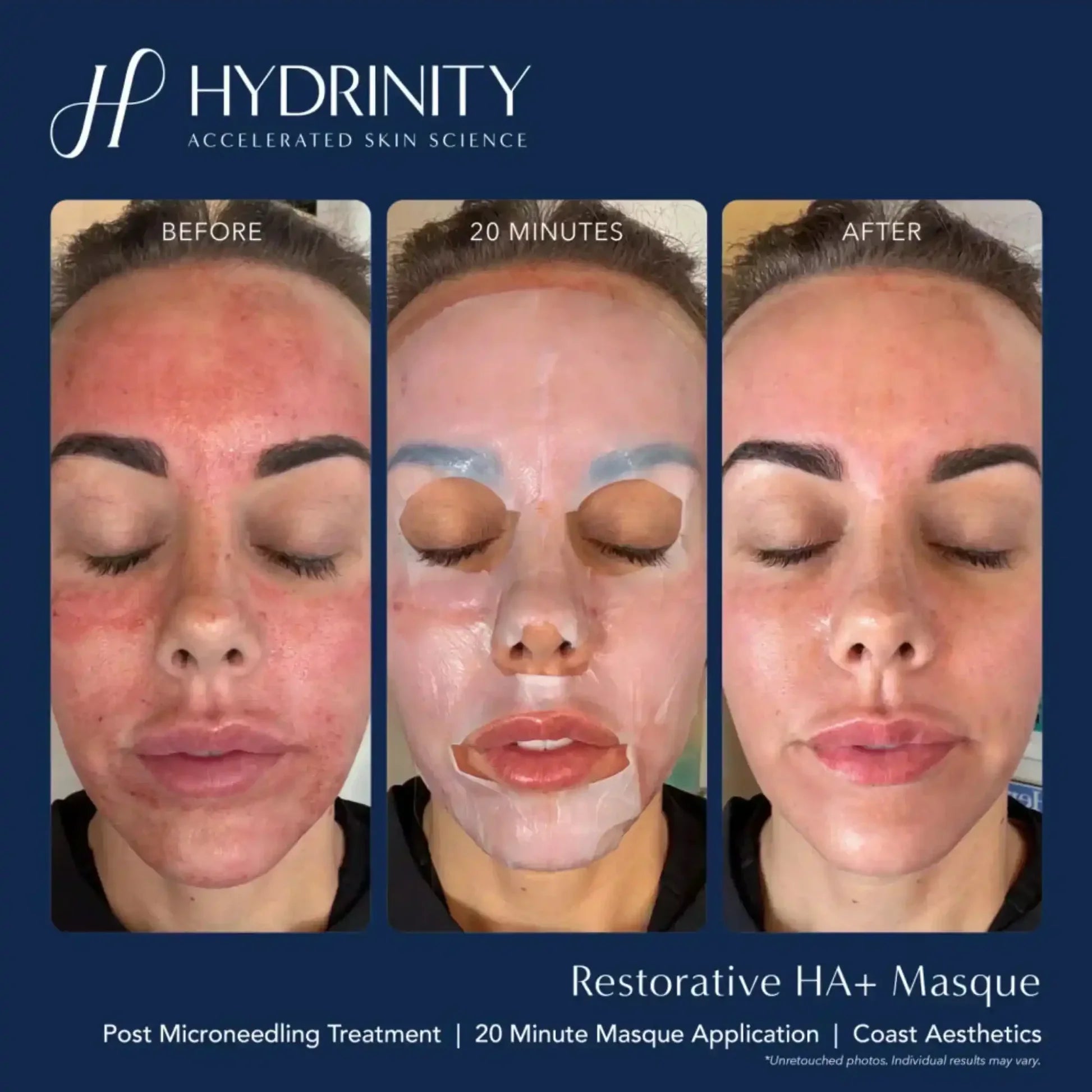 Hydrinity Restorative HA Masque