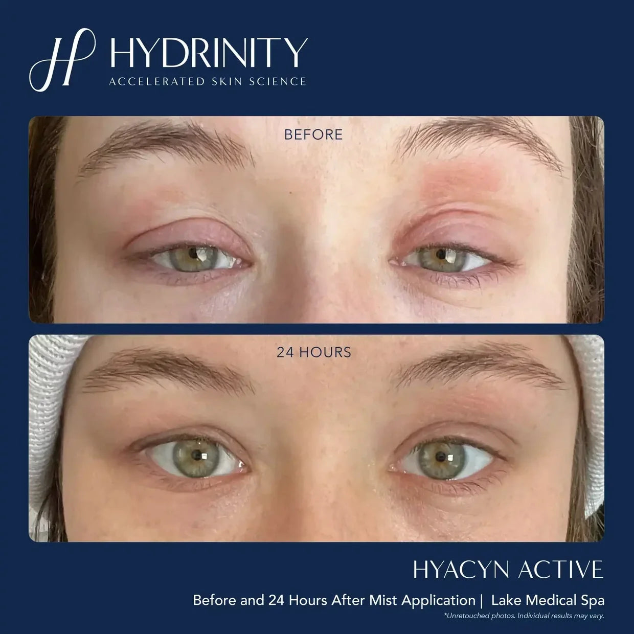 Hydrinity Hyacyn Active Mist