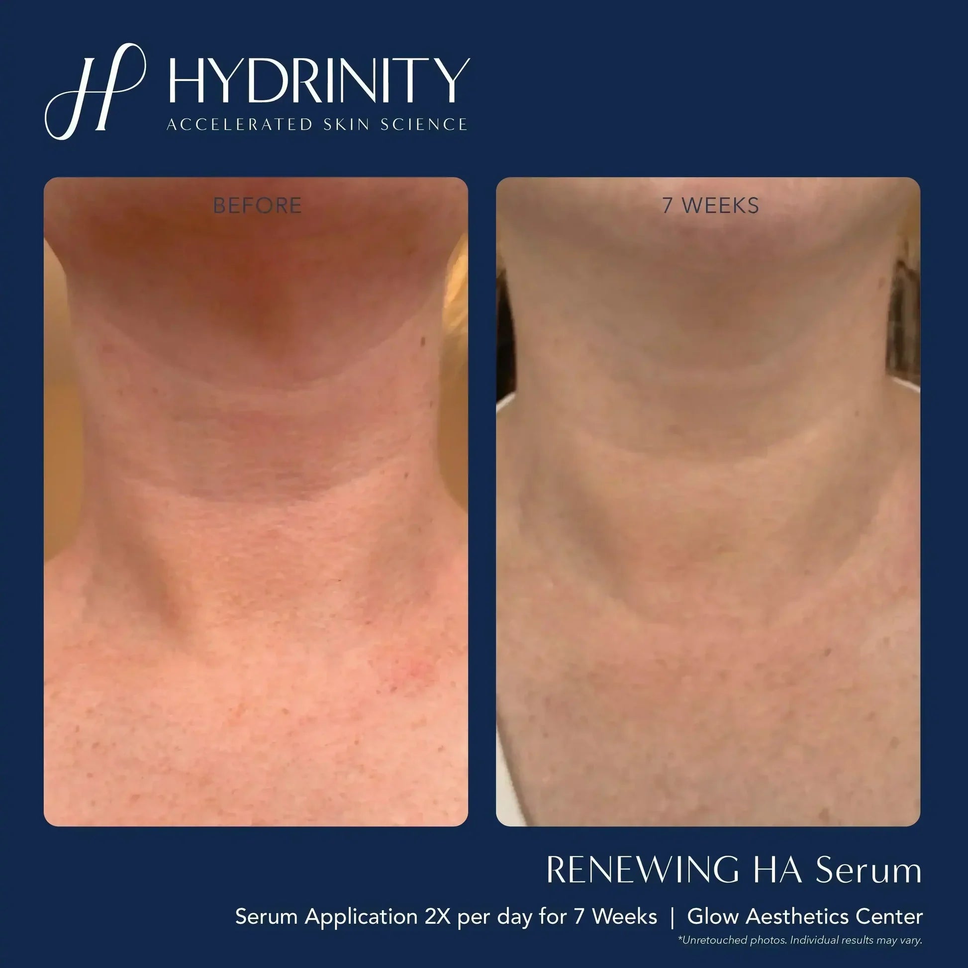 Hydrinity Renewing Serum